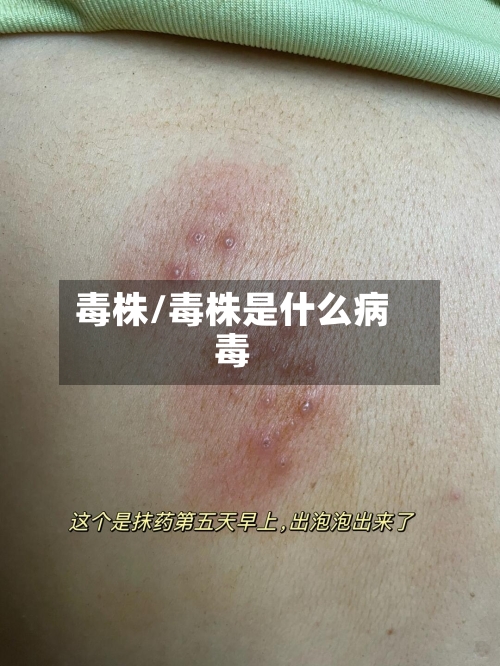 毒株/毒株是什么病毒